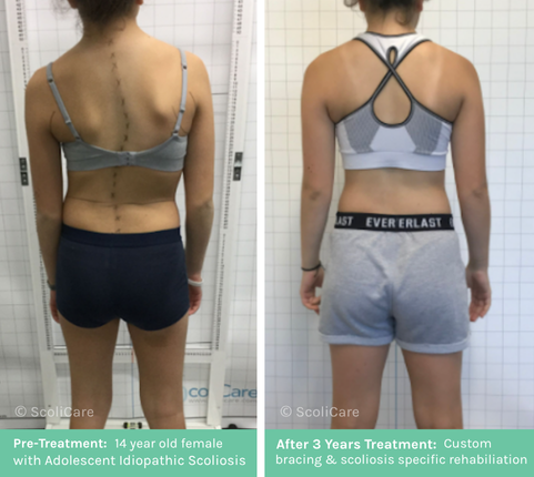 AIS (1) Adolescent Idiopathic Scoliosis