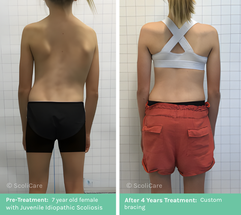 Juvenile (1) Juvenile Scoliosis